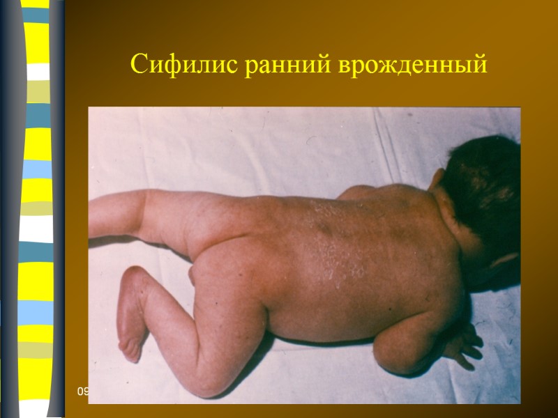 09.12.2017 Сифилис ранний врожденный